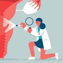 Illustration depicting a health care professional examining the uterus for signs of cervical cancer