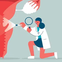 Illustration depicting a health care professional examining the uterus for signs of cervical cancer