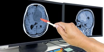 A doctor points out the location of the brain tumor on the computer screen showing an MRI result.