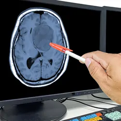 A doctor points out the location of the brain tumor on the computer screen showing an MRI result.