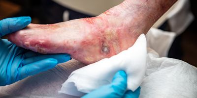 A clinician holds a clean cotton pad to tend to Epidermolysis bullosa, open wounds, and cysts on a patient's foot.