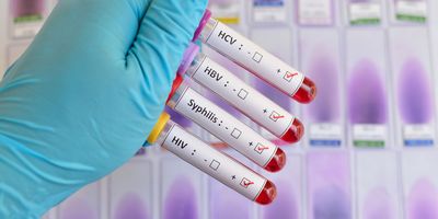 Gloved hand holds four tubes with blood sample positive for sexually transmitted diseases: HIV, HBV, HCV, Syphilis 