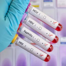 Gloved hand holds four tubes with blood sample positive for sexually transmitted diseases: HIV, HBV, HCV, Syphilis