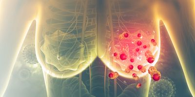 3D illustration of Breast cancer