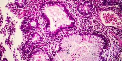 Villous colon adenocarcinoma, light micrograph, photo under microscope 