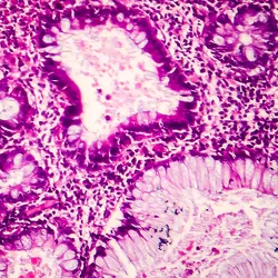 Villous colon adenocarcinoma, light micrograph, photo under microscope 