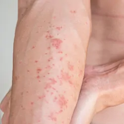 Arm of a man showing Atopic dermatitis, a skin condition all over the body.