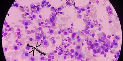 Microscopic image of bone marrow with plasma cell dyscrasia or multiple myeloma.
