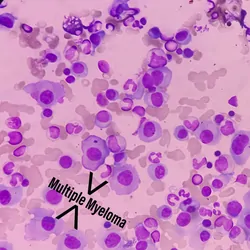Microscopic image of bone marrow with plasma cell dyscrasia or multiple myeloma.