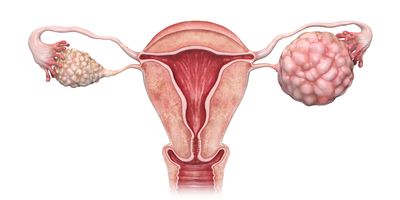 3D rendered illustration of ovarian cancer.