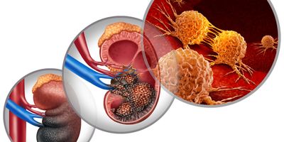 3D illustration of malignant cells in a human body attacking the urinary system and renal carcinoma anatomy as a symbol for tumor growth treatment and risk.