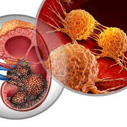 3D illustration of malignant cells in a human body attacking the urinary system and renal carcinoma anatomy as a symbol for tumor growth treatment and risk.