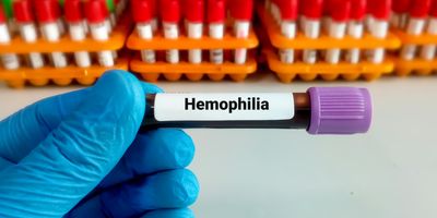 Blood sample for hemophilia test, an inherited genetic disorder