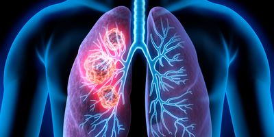 3D illustration of lung cancer showing a cancerous area in the left lung