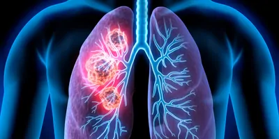 3D illustration of lung cancer showing a cancerous area in the left lung