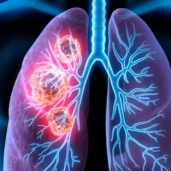 3D illustration of lung cancer showing a cancerous area in the left lung