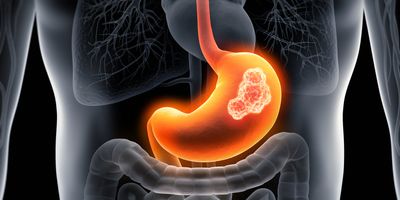 Graphical illustration of an Xray showing tumors in stomach, gastric cancer