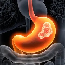 Graphical illustration of an Xray showing tumors in stomach, gastric cancer