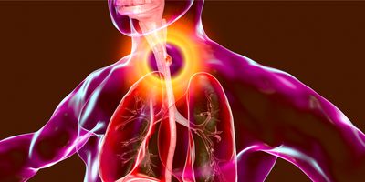 3D illustration showing a malignant tumor in the human esophagus
