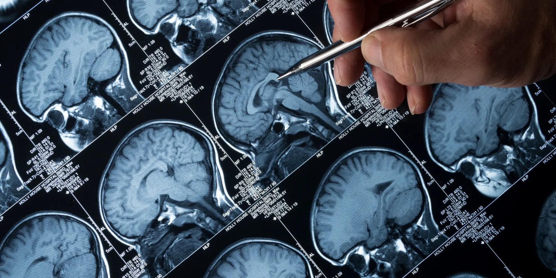 MRI brain scan of head and skull with hand pointing