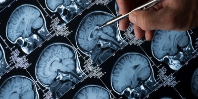 MRI brain scan of head and skull with hand pointing