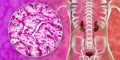 3D illustration and light micrograph of kidney cancer, renal cell carcinoma.