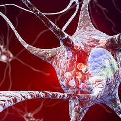 3D illustration showing neurons containing Lewy bodies small red spheres which are deposits of proteins accumulated in brain cells that cause their progressive degeneration.