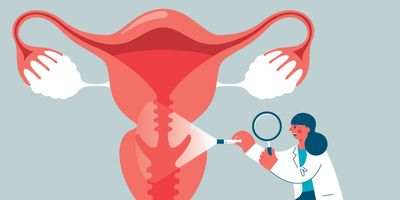 A stock illustration of a doctor examining a uterus. 