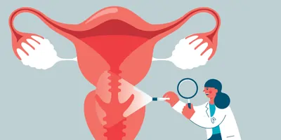 A stock illustration of a doctor examining a uterus.
