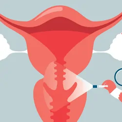 A stock illustration of a doctor examining a uterus. 