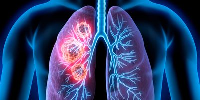 3D illustration of the cancerous area in human lungs