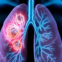 3D illustration of the cancerous area in human lungs