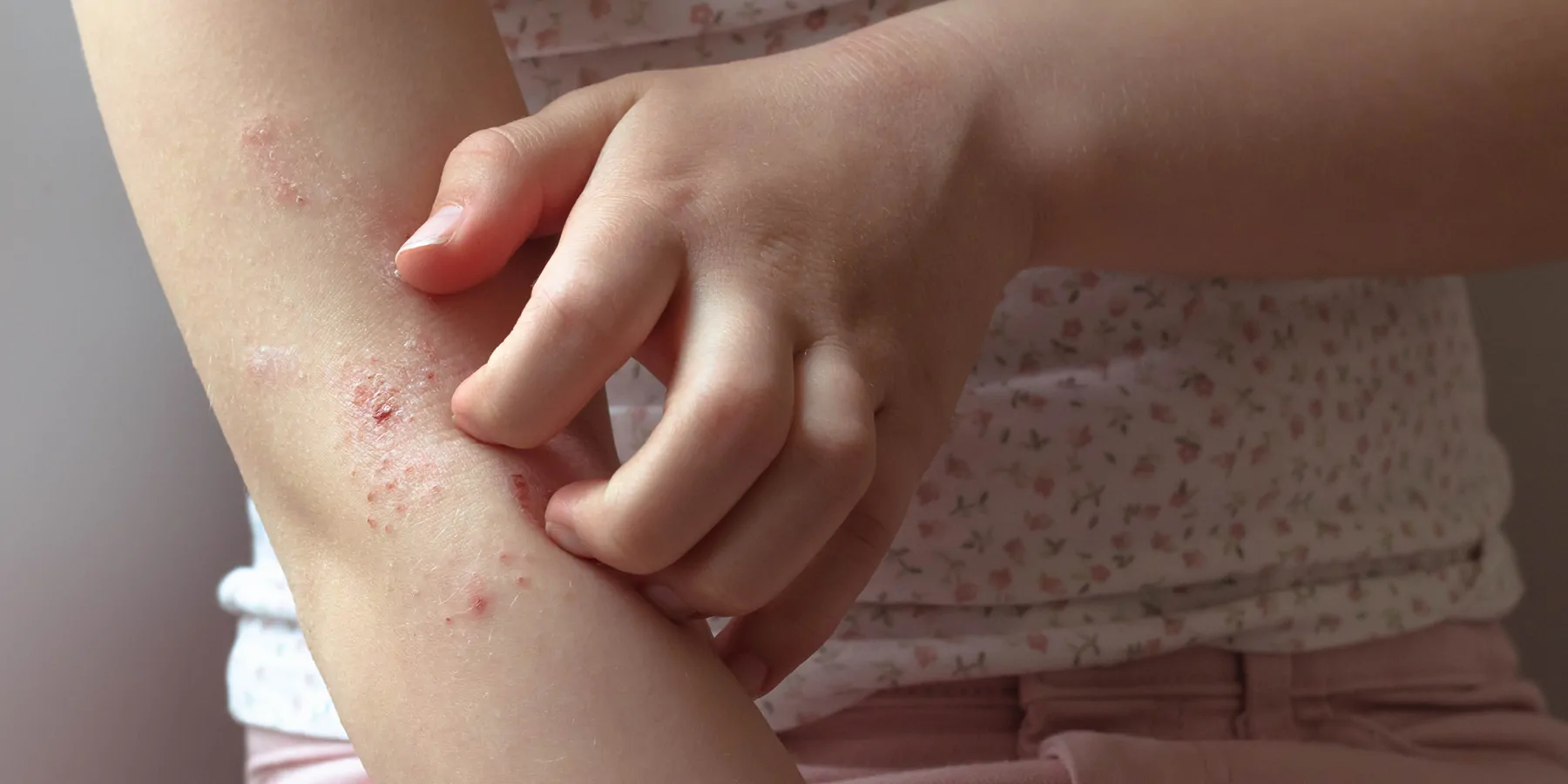 A girl scratches eczema on her right hand using her left hand.