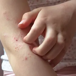 A girl scratches eczema on her right hand using her left hand.