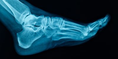 Human Foot X-ray Image showing bones and soft tissue.