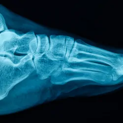 Human Foot X-ray Image showing bones and soft tissue.