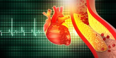 3D illustration of a blocked artery beside a human heart against an ECG in the background.