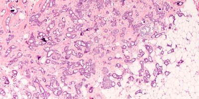 Microscopy photo of breast cancer sample with histologic staining.