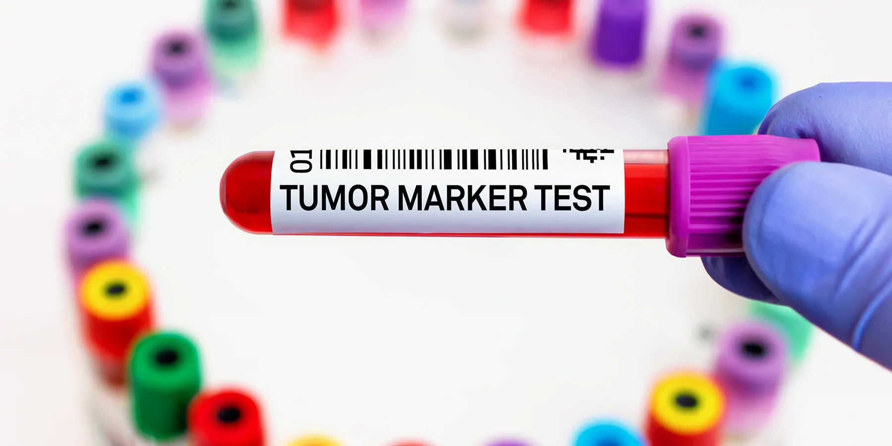 A clinician holds a blood vacutainer labeled "Tumor marker test" for analysis of cancer biomarkers.