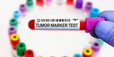 A clinician holds a blood vacutainer labeled "Tumor marker test" for analysis of cancer biomarkers.