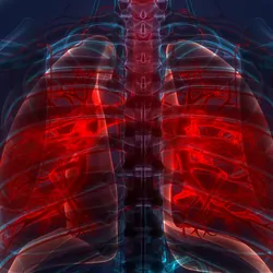 3D illustration of human lungs with highlighted infected areas.