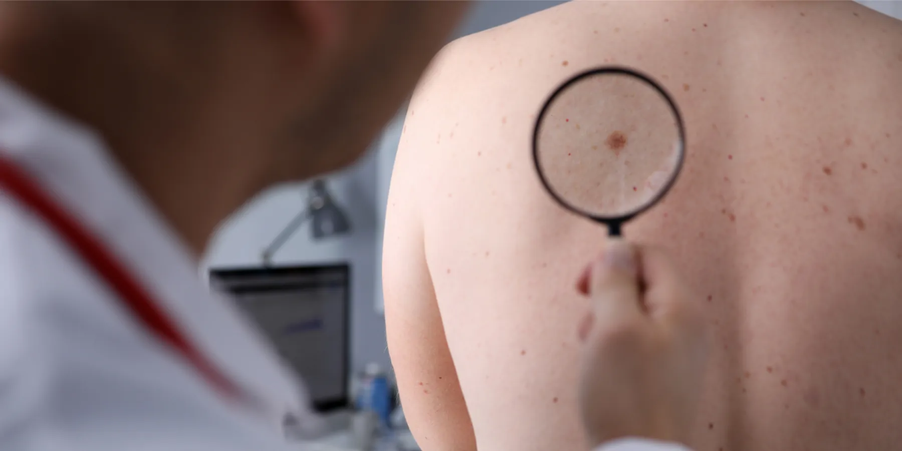 Neoadjuvant Shows Positive Response in Advanced Melanoma Trial The male clinician looks at spots and moles on a patient's back through a magnifying glass.