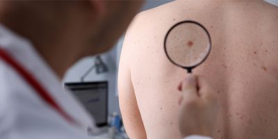 The male clinician looks at spots and moles on a patient's back through a magnifying glass.