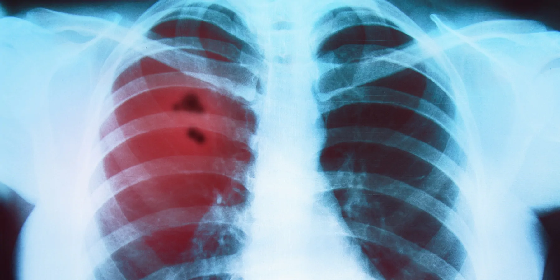 X-ray of the lungs of a person with highlighted cancer in the left lung.