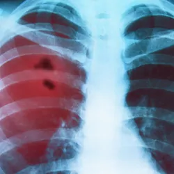 X-ray of the lungs of a person with highlighted cancer in the left lung.