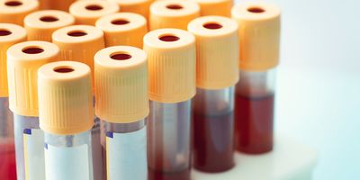 Yellow-capped vacutainers containing blood samples arranged in a test tube stand.