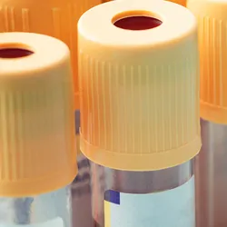 Yellow-capped vacutainers containing blood samples arranged in a test tube stand.