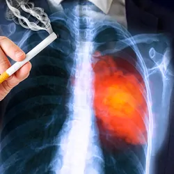A man holding a cigarette before his chest where his lungs can be seen as an X-ray film showing a reddened affected area on the left.