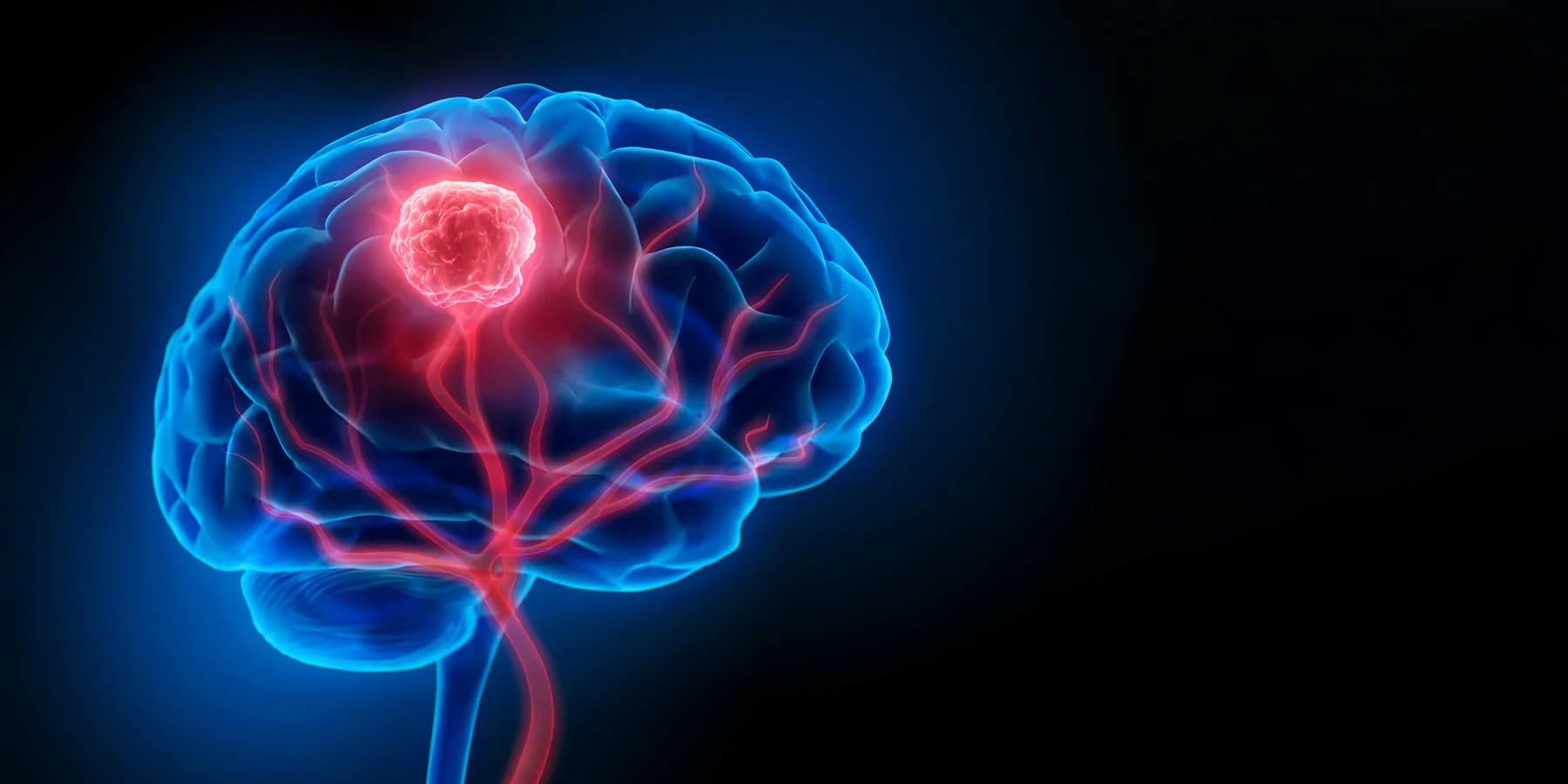 3D illustration of a human brain with tumor.