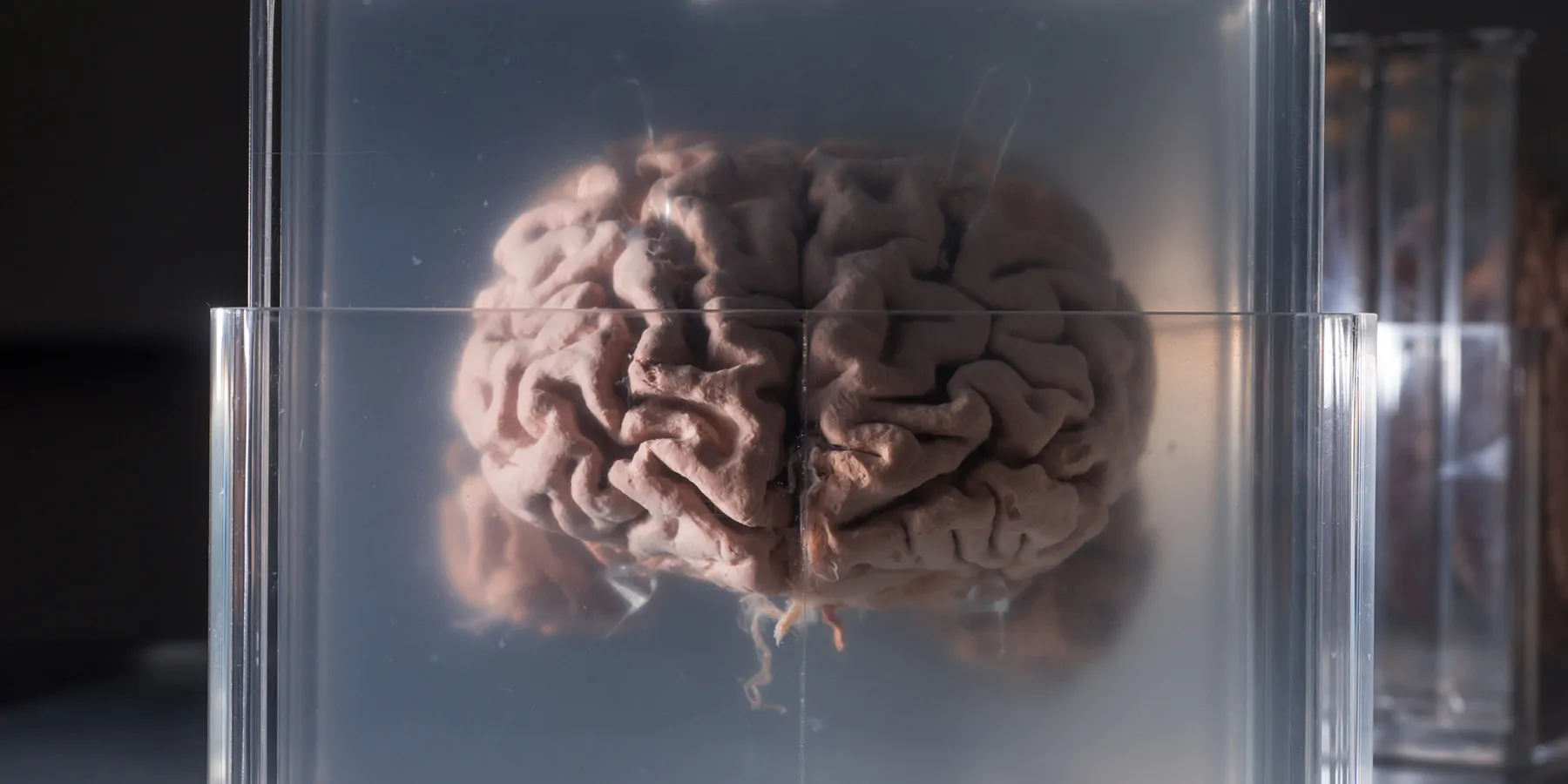 World’s First Brain Biobank Accelerates Clinical Research Human brain samples preserved in plastic slides.